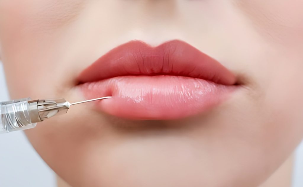 0.5ml Lip Fillers - £120