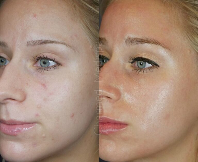 Charmed-Medispa-Microneedling-Delaware