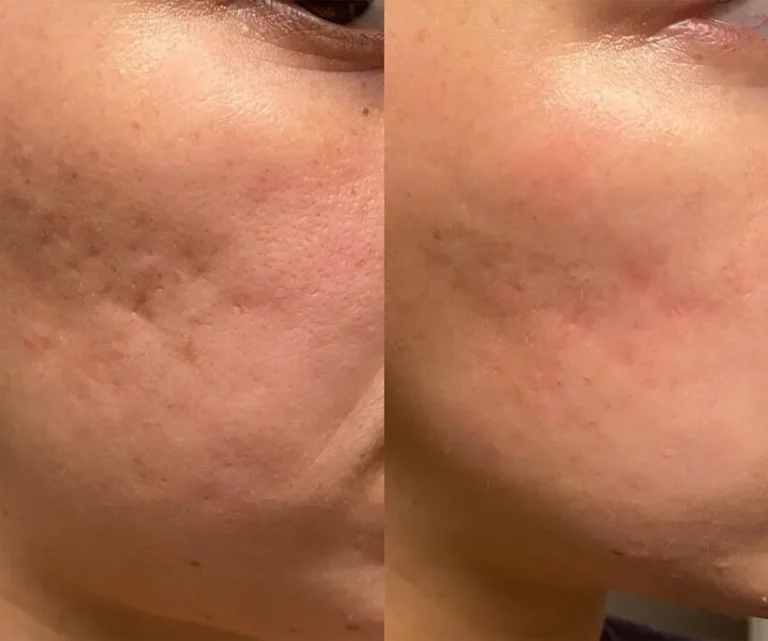 microneedling-for-all-types-of-scars